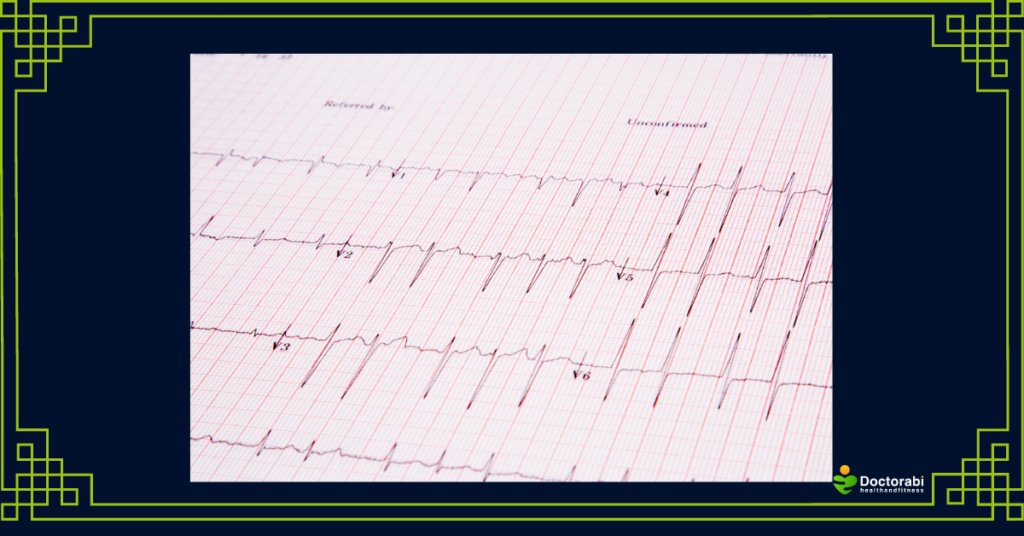 EKG-Heart-Tracing